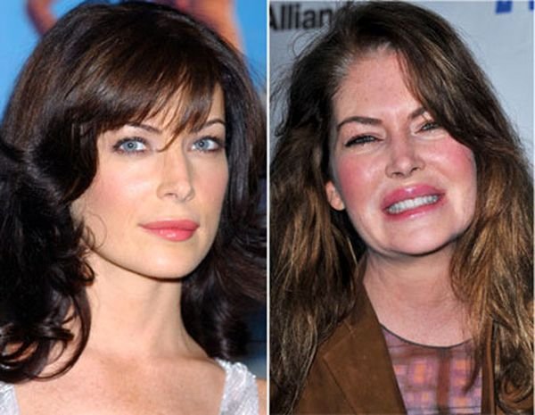 Celebrity-plastic-surgery-faces-before-after3.jpg