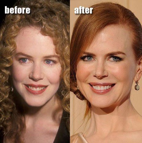 nicole-kidman-plastic-surgery-before-after.jpg
